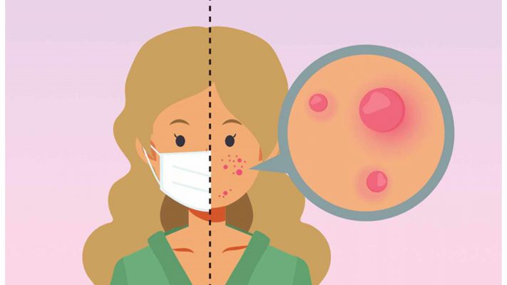 پیشگیری-و-درمان-ماسکنه